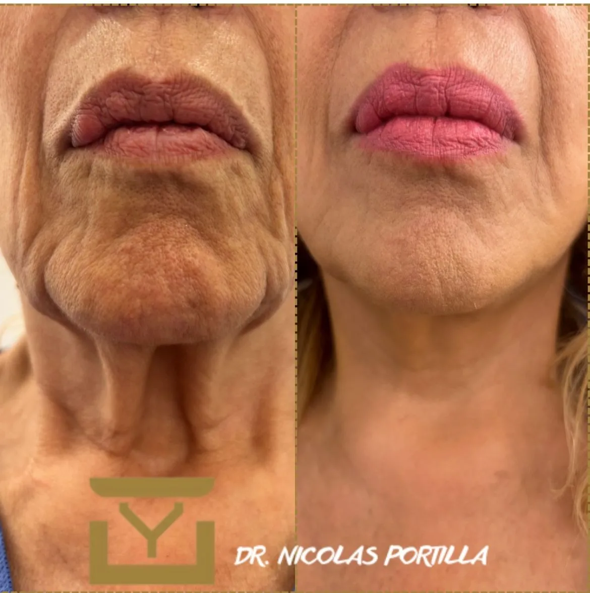 Resultado de Endolift en Sevilla antes y después