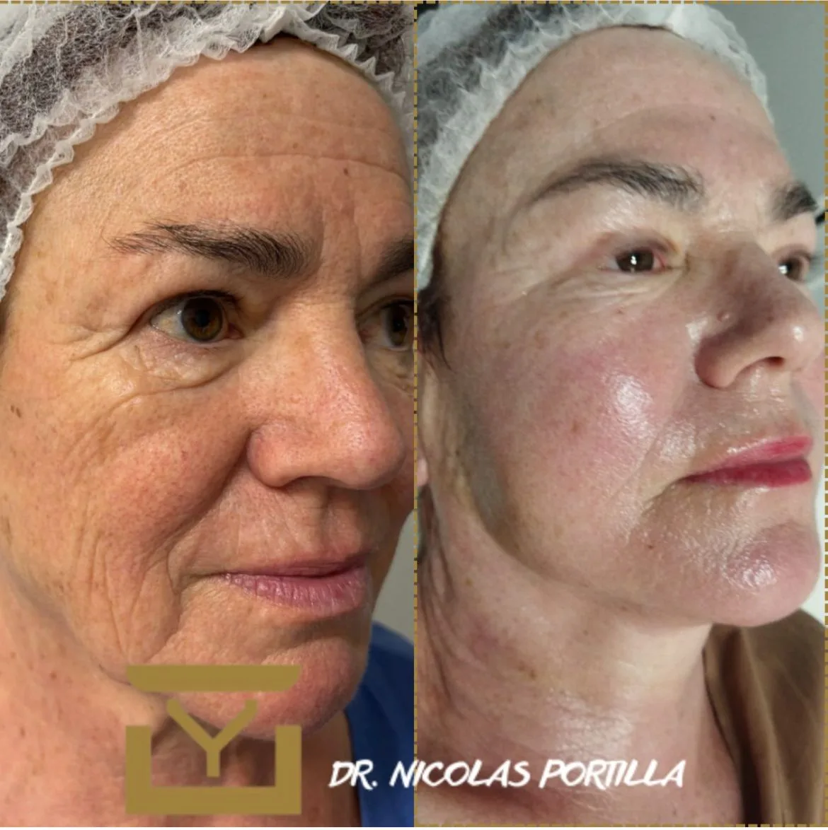 Endolift antes y después, Dr. Nicolás Portilla