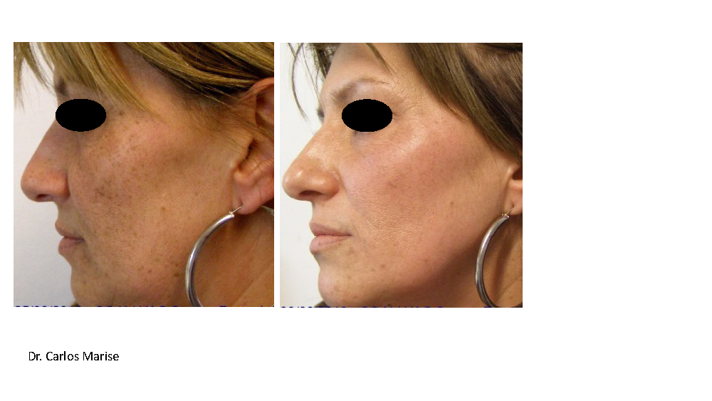 HarmonyXL Pro-IPL 570nm Rostro o Escote
