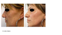 HarmonyXL Pro-IPL 570nm Rostro o Escote