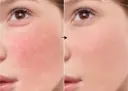 Rutin-TX 3% de la marca Universkin: Resultados